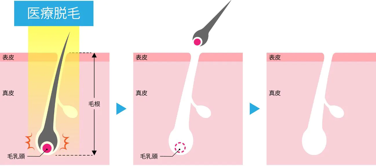 医療脱毛とは