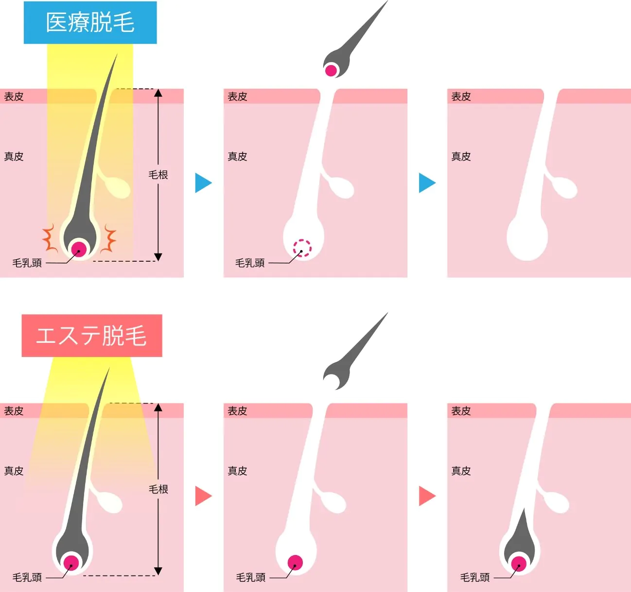 医療脱毛とエステ脱毛の違い